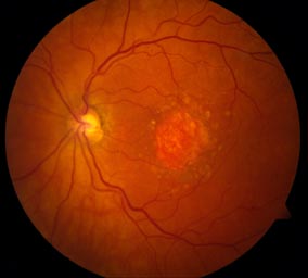 A fundus photo showing geographic atrophy associated with dry age-related macular degeneration.