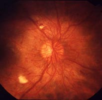 Image of proliferative retinopathy showing abnormal new blood vessels and scar tissue on the surface of the retina