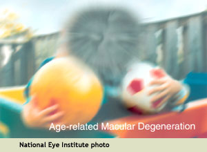 NEI image of how someone with macular degeneration sees: overall blurriness with a blind spot in the center