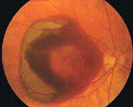 image of eye affected by neovascular age-related macular degeneration