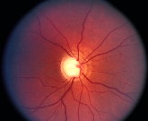 photograph of retina showing glaucomatous cupping of the optic disc