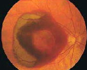 Photograph of a retina with cupping of the optic disc from glaucoma