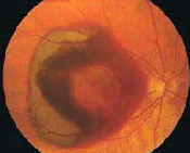 retina with wet AMD