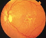 A retinal photograph of dry AMD