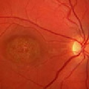 Retinal photograph of Stargardt's disease