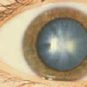 Photo of an eye with a cortical cataract. Source: National Eye Institute