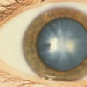 cortical cataract