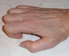 Finger curled into palm. Incorrect position