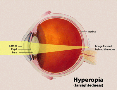 diagram showing how, in a person with hyperopia, light rays are brought to focus behind the retina