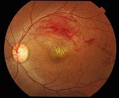 Photograph of a retina with branch retinal vein occlusion