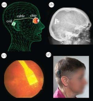 Four-part diagram of the retinal implant system