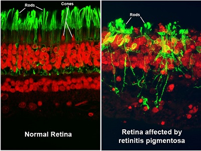 people with retinitis pigmentosa