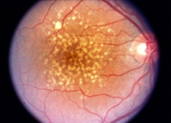 Photograph of a retina with drusen