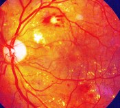 retina with diabetic retinopathy