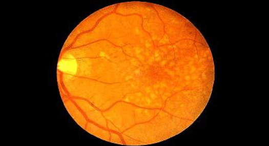 retina with dry macular degeneration photo by Carolina Retina