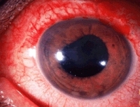 an eye with anterior uveitis