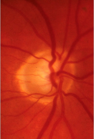 An optic disc with neuroretinal rim thinning. Source:University of Michigan College of Optometry
