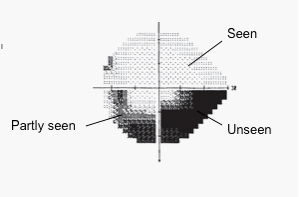 Map of visual field deficits. Source: Author