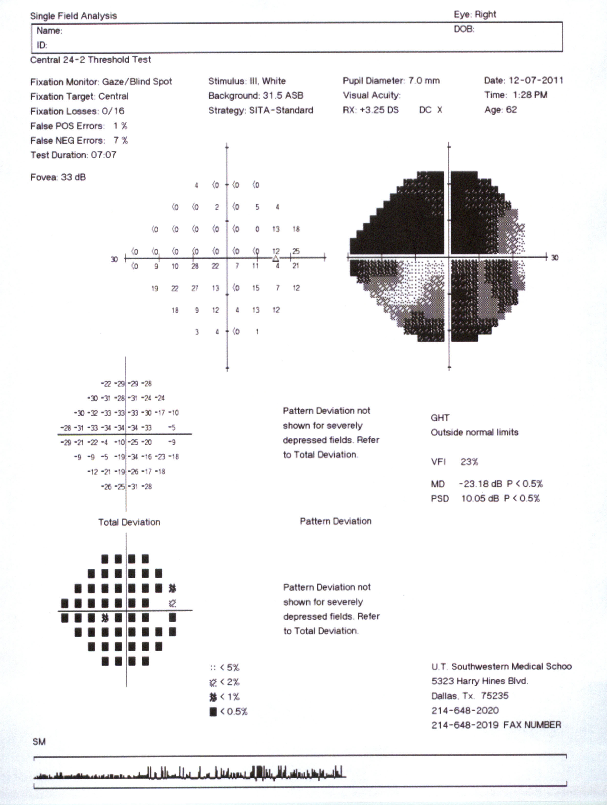 Visual field map showing advanced visual field damage. Source: Courtesy Karanjit Kooner MD and William Anderson, photographer, University of Texas Southwestern Medical Center, Dallas.