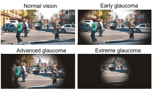 Series of four photos demonstrating typical progression of vision loss due to glaucoma. Source: National Eye Institute