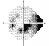 A visual field map showing scotomas (dark areas). Source: Author.