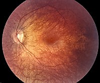 a retina with Leber's congenital amaurosis