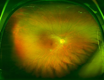 a normal fundus