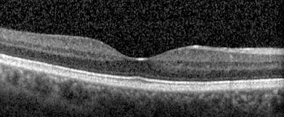 OCT of normal retina