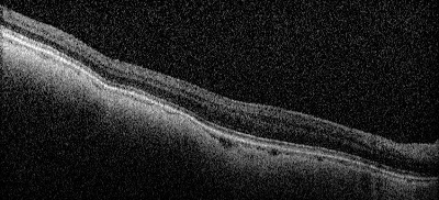 OCT albinism retina