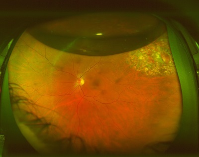 retinal detachment after treatment with vitrectomy and gas