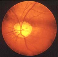 Photograph of the human retina with the optic nerve affected by glaucoma