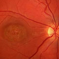 A retinal photograph that shows Stargardt disease